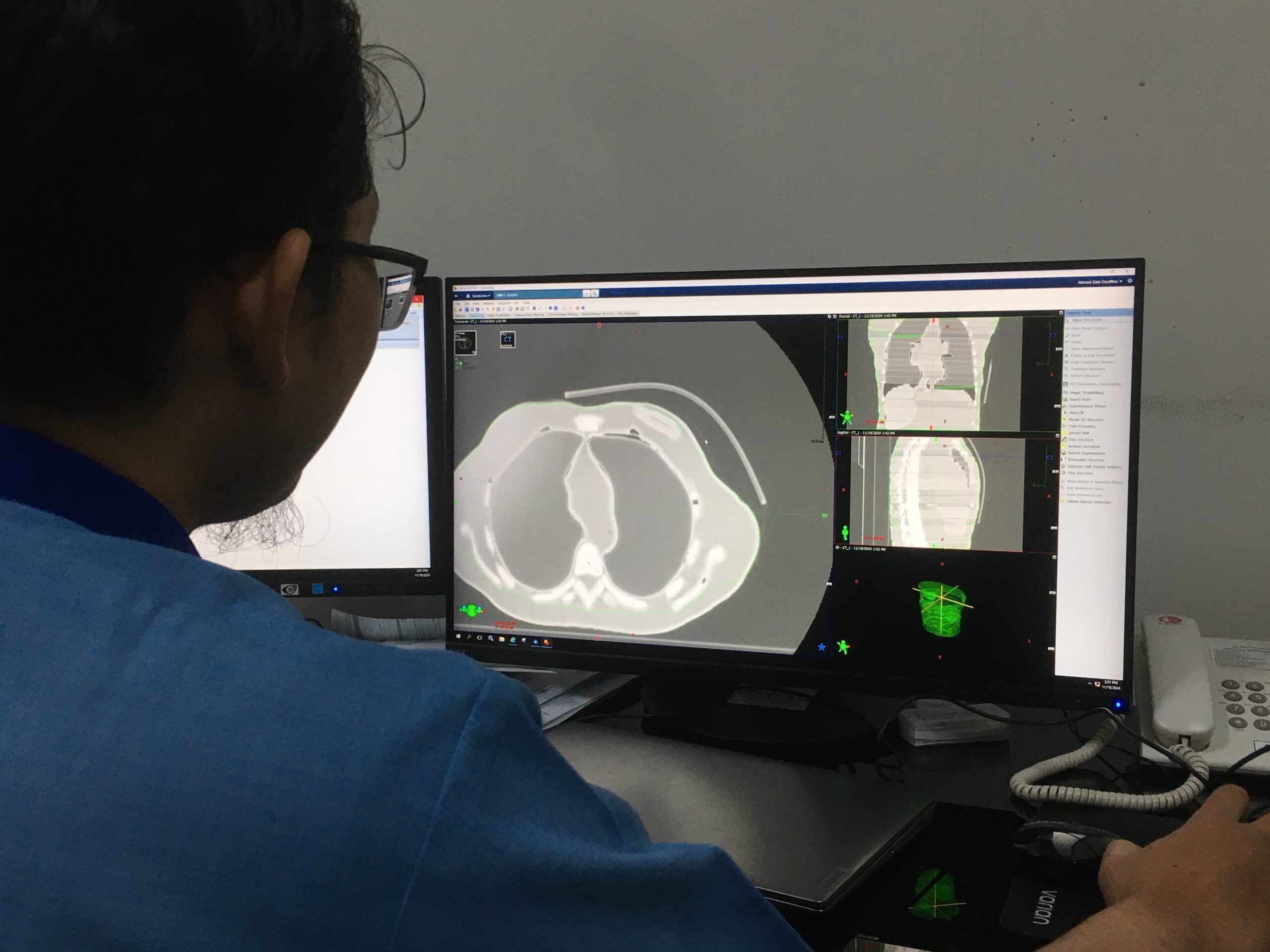 Proses evaluasi citra hasil pemindaian Fantom Antropomorfik pada perangkat lunak radioterapi