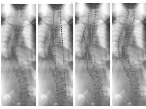 SCPM pada penentuan tulang belakang penderita skoliosis dari awal (kiri) hingga partikel sempurna mengikuti tulang belakan (kanan)